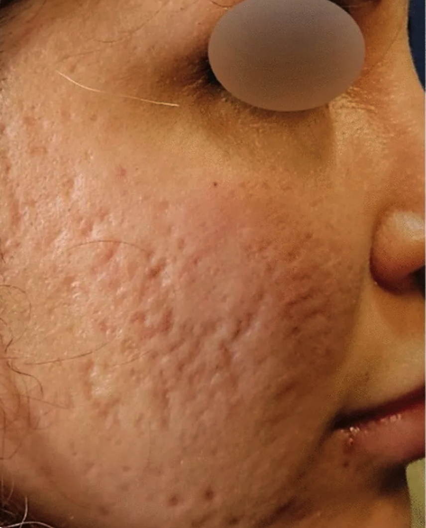 Severe Acne Scar & Texture Resurfacing - Before