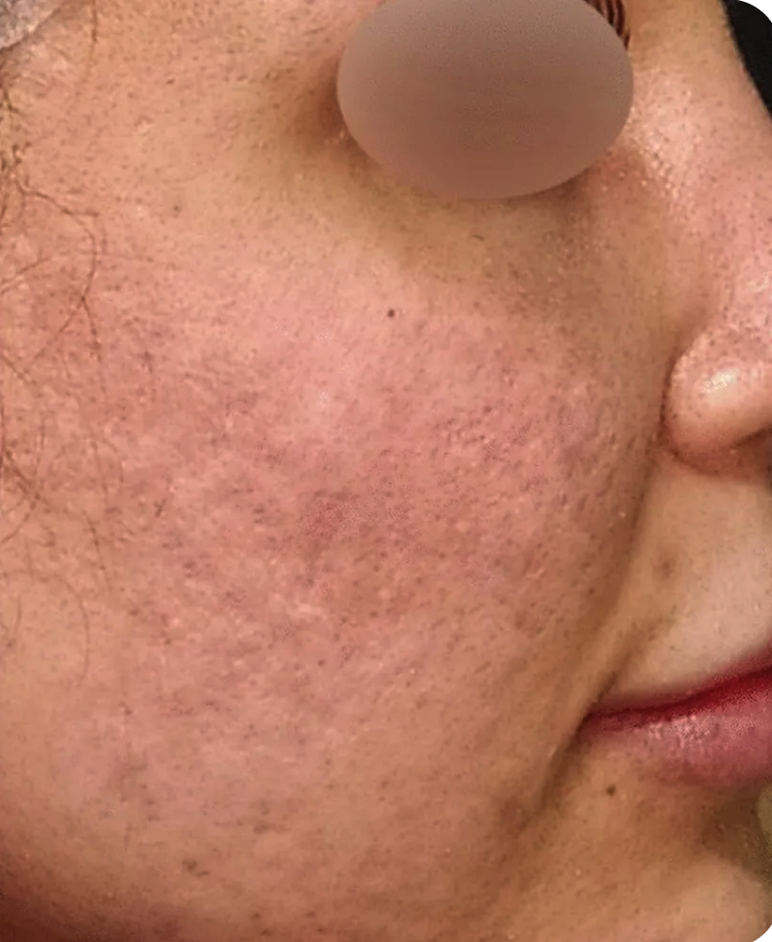 Severe Acne Scar & Texture Resurfacing - After