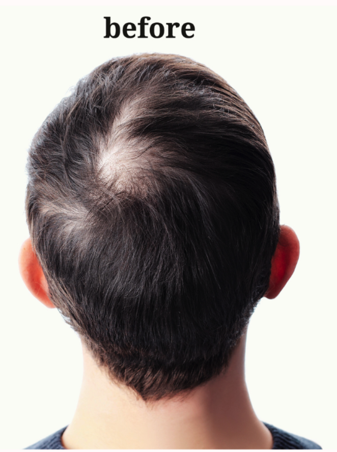 Hair Loss & Thinning Therapy( Hair Treatment) - Before