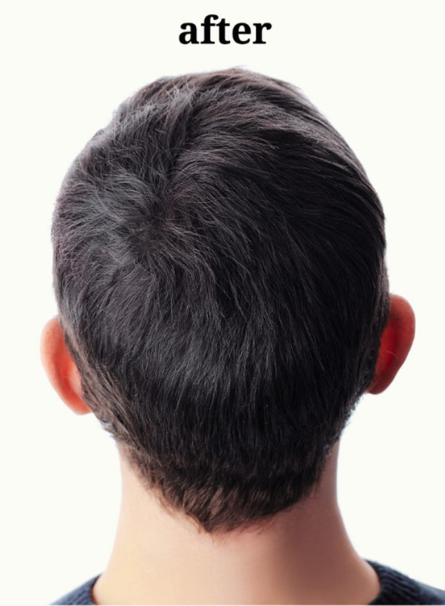 Hair Loss & Thinning Therapy( Hair Treatment) - After