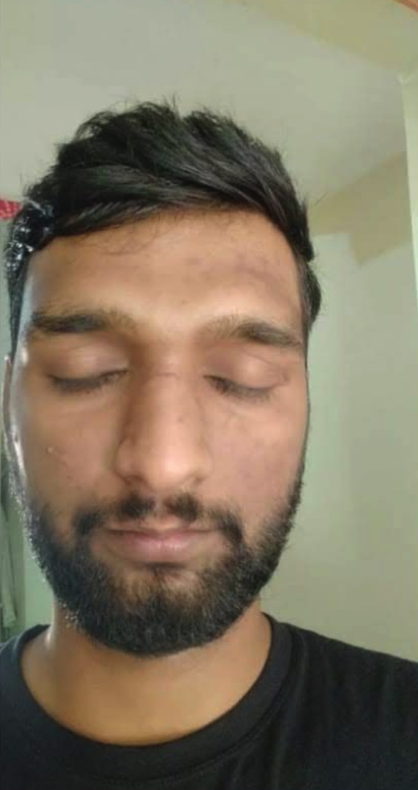 Melasma & Stubborn Pigmentation Clearance - After