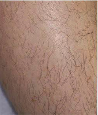 Laser hair removal - Before