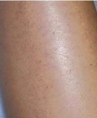 Laser hair removal - After