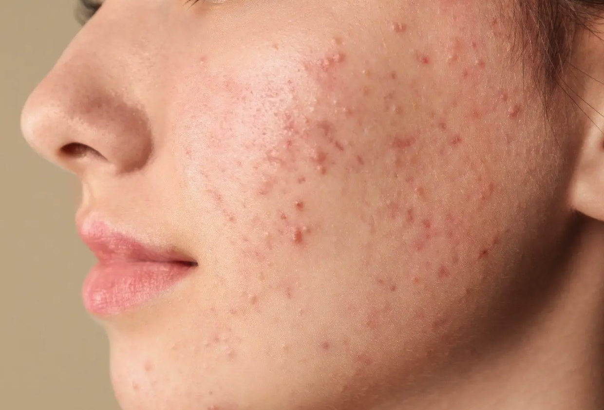 Acne & Pimples Treatment