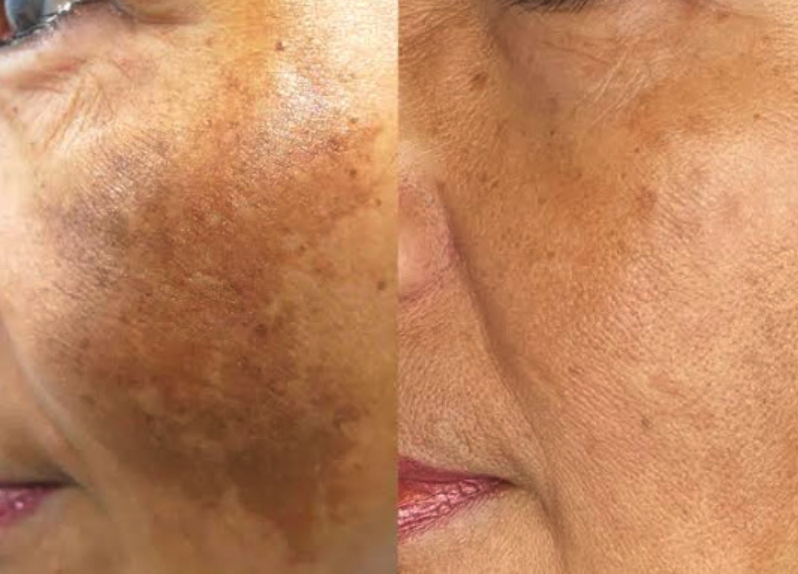 Chemical Peels & Skin Brightening