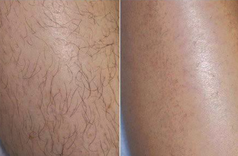 Painless Laser Hair Reduction (LHR)