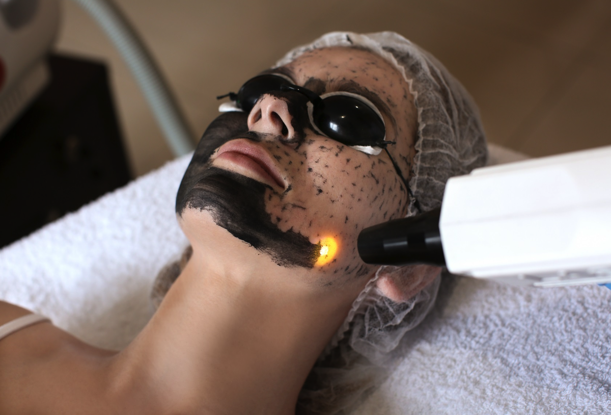 Hollywood Carbon Laser Facial