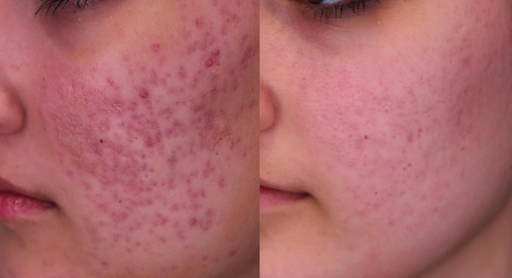 Acne Scars & Marks Resurfacing