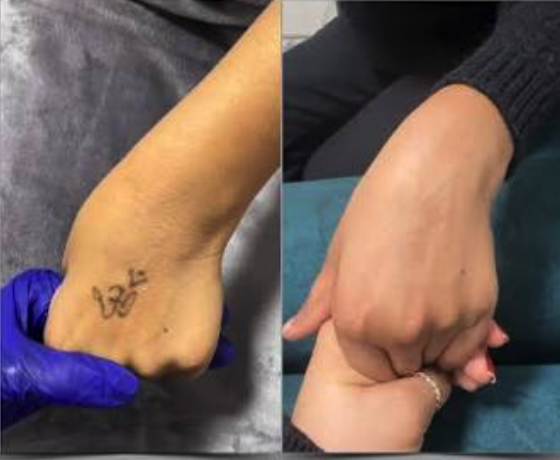 Q-Switched Tattoo Removal