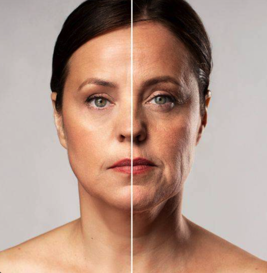 Non-Surgical Face Lift & Skin Tightening