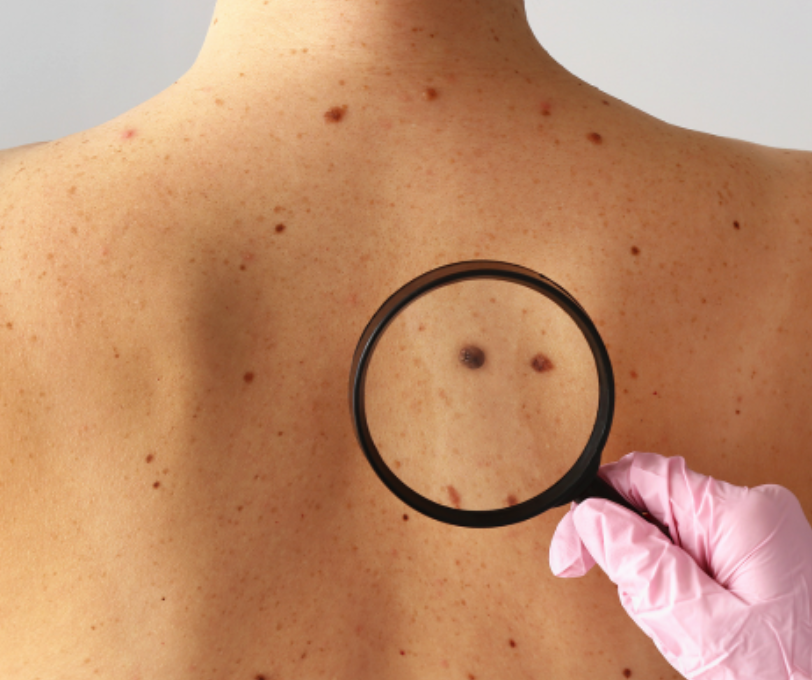 Warts, Moles & Corn Removal