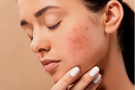 Acne Treatment in Hadapsar